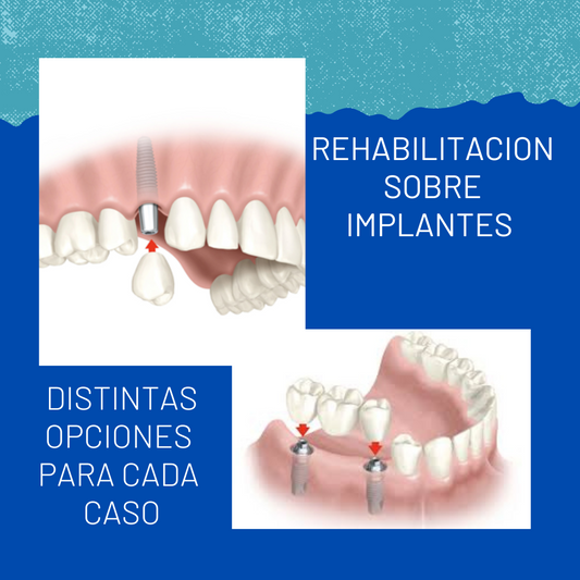 3. REHABILITACION SOBRE IMPLANTES EN CEREC